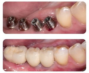 синус-лифтинг в стоматологии