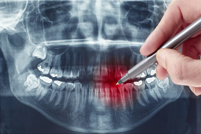 панорамный снимок зуба в махачкале