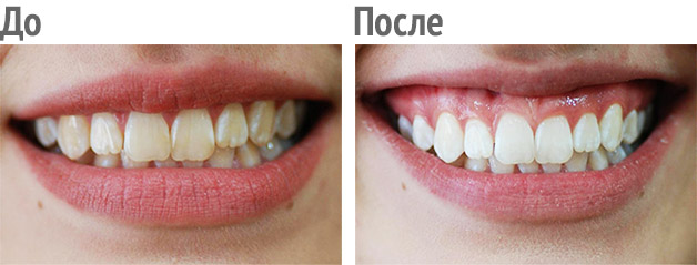 до и после ультрозвуковой чистки зубов
